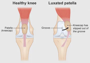 Anatomical illustration comparing normal patellar tracking with a displaced kneecap