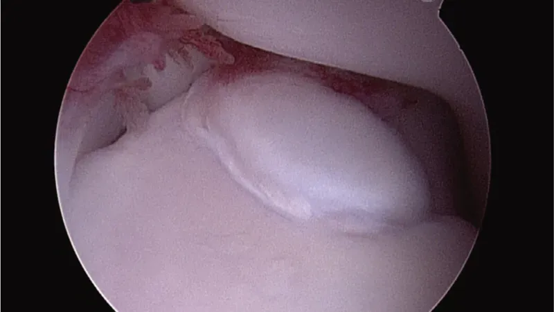 Arthroscopic view of FCP