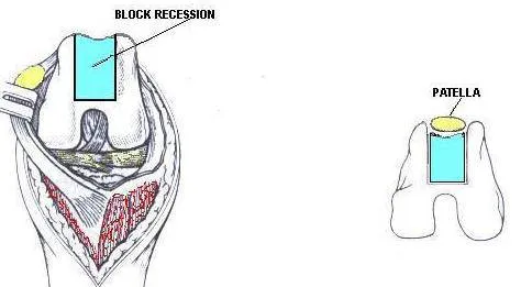 Diagrammatic representation of a rectangular block recession trochleoplasty