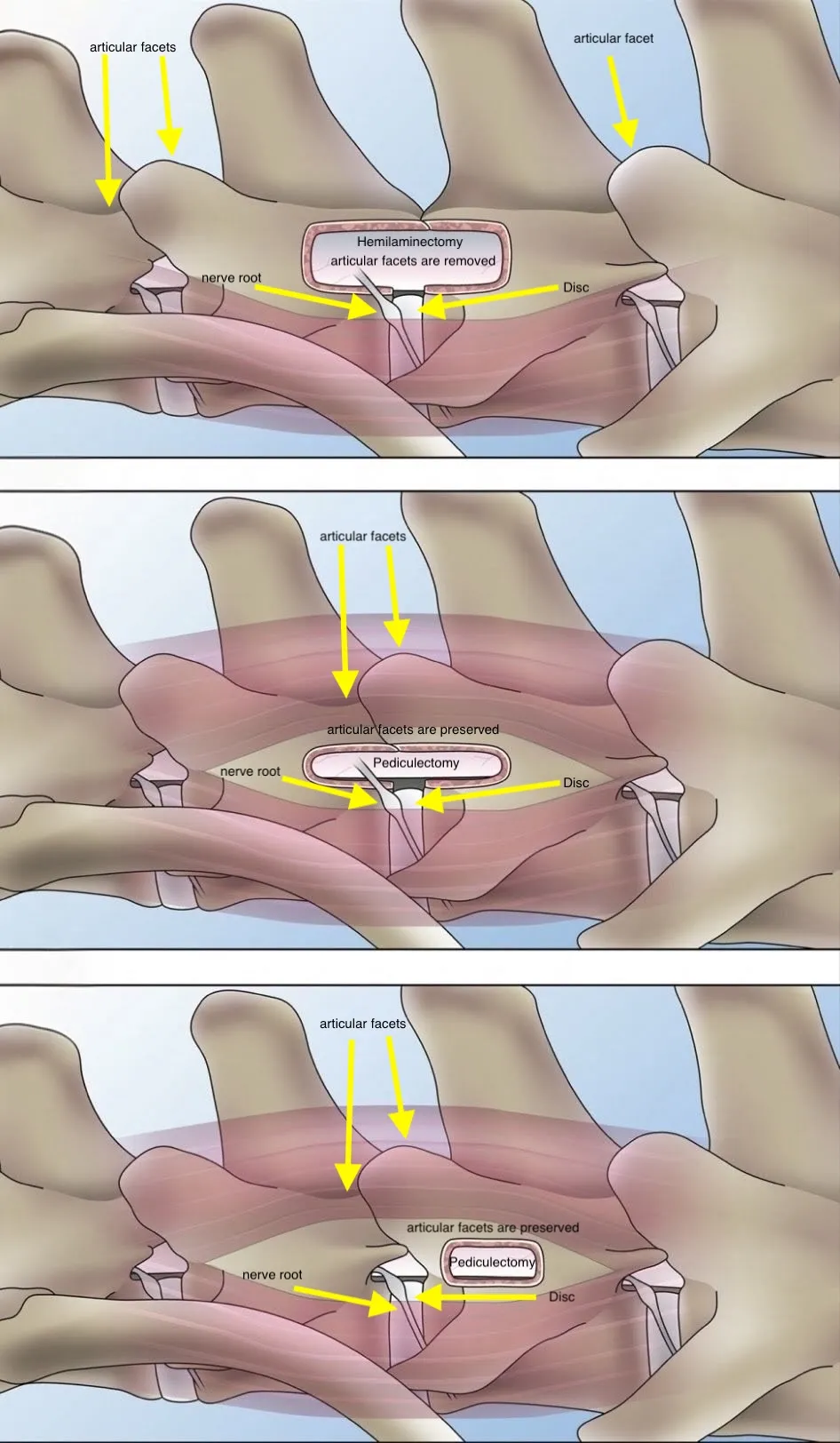 Illustration comparing hemilaminectomy, which removes the articular facets, with pediculectomy approaches that preserve them