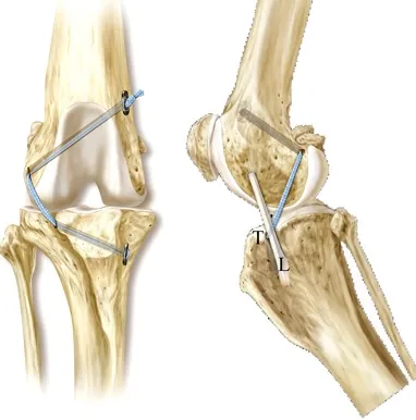 ECR Suture illustration