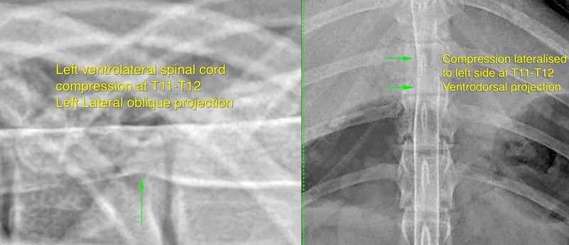 Spinal advanced imaging showing herniated disc material compressing the neural canal