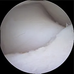 Arthroscopic view of Subtotal Coronoidectomy (SCO)